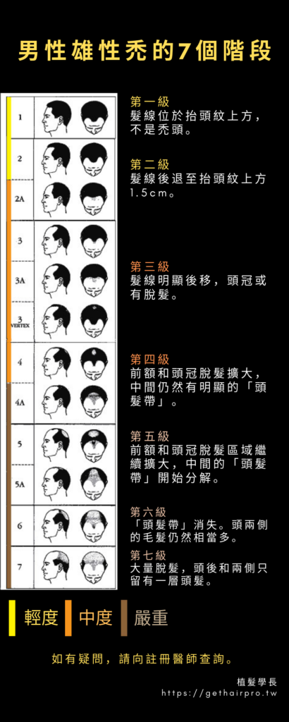 男性雄性禿的7個階段