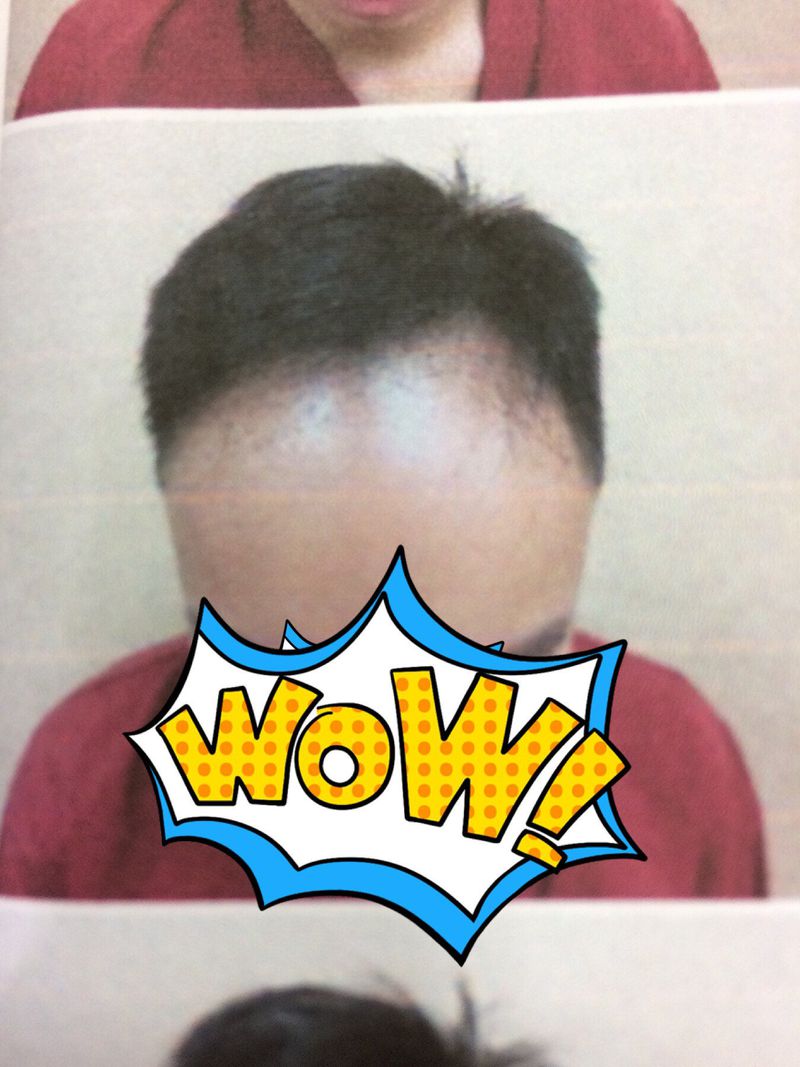 台北植髮－手術前