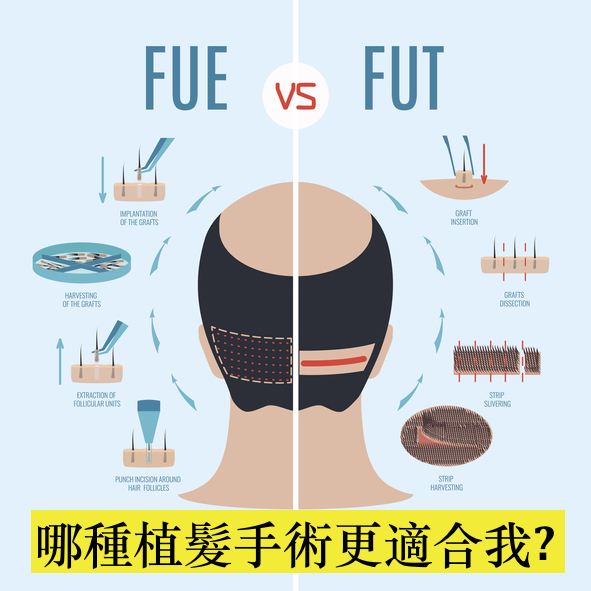 FUE vs FUT 哪種植髮手術更適合我?