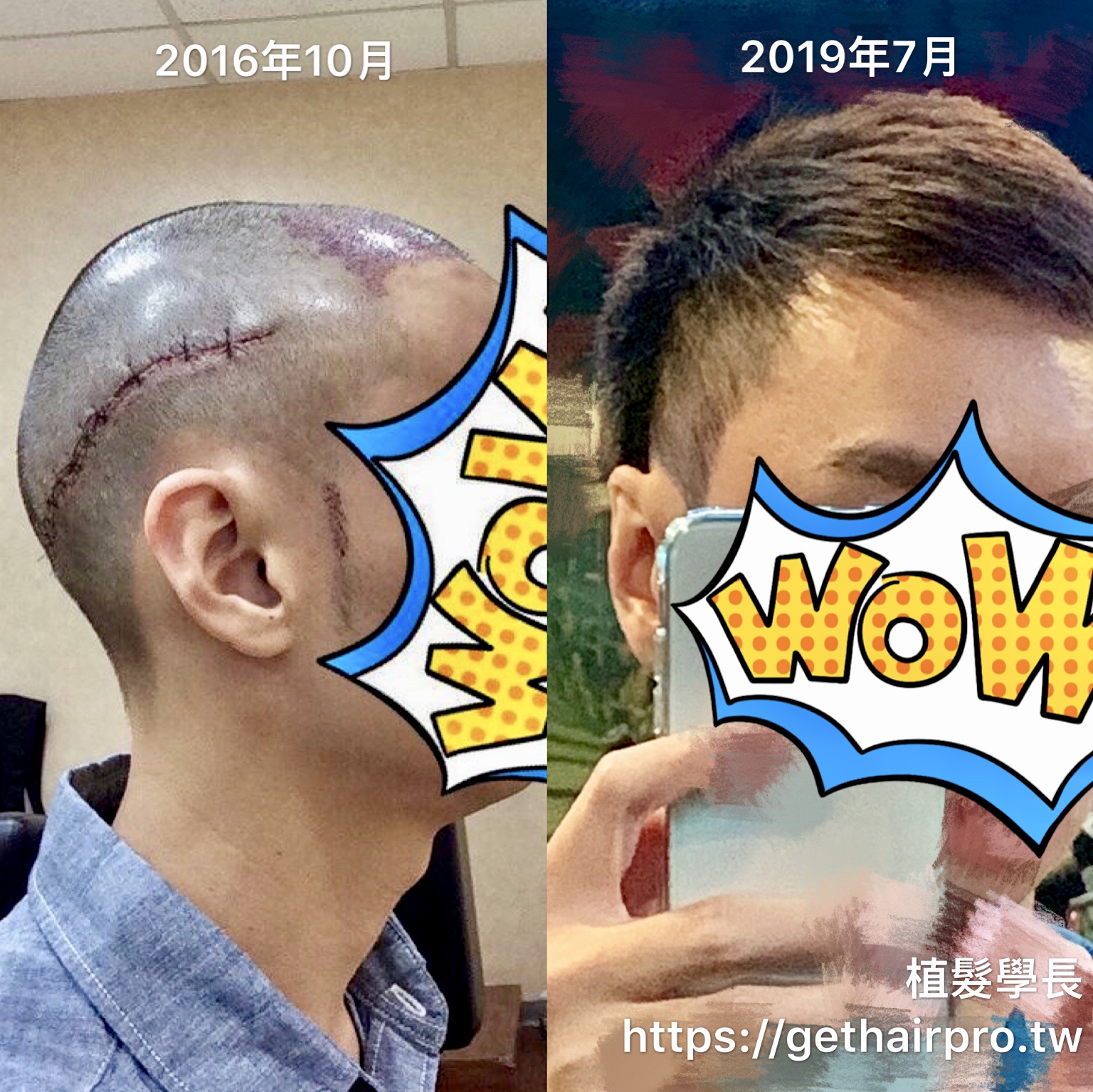 植髮手術後2年9個月：頭側疤痕不見了